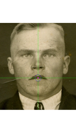 Stomion marking on a photograph in frontal view (left)