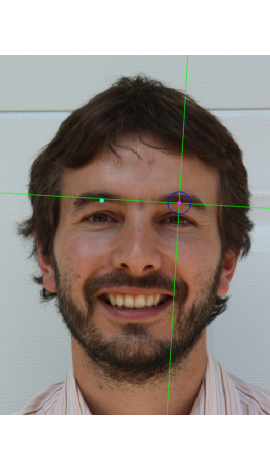 Marcado de mid-supraorbital en una fotografía en vista frontal (izquierda)