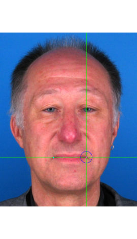  Examples of cheilion marking on frontal view photographs