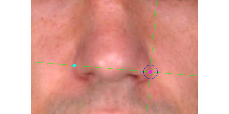 Imagen de una base nasal asimétrica. El alare izquierdo se sitúa más bajo en relación al alare derecho