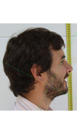 Estimación de gonion en una fotografía en vista lateral (centro)