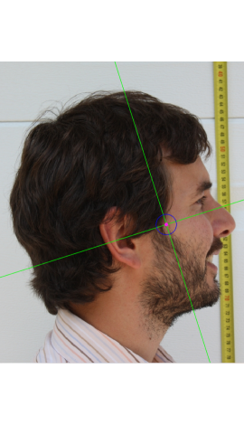 Estimación de zygion en una fotografía en vista lateral (centro)