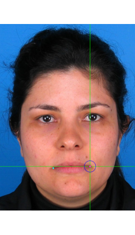 Ejemplos de marcado de cheilion en fotografías en vista frontal