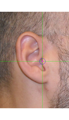 Tragion marking on a photograph in lateral view (center)