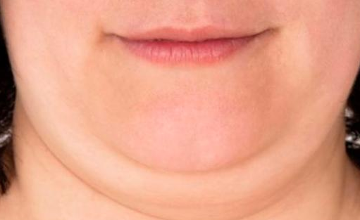 Example of a subject with adipose tissue that obscures the facial contour