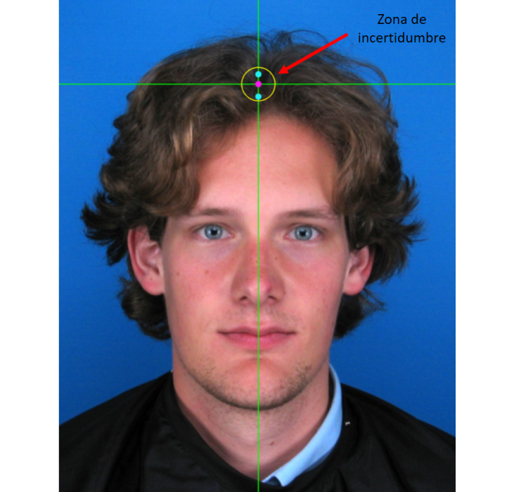 Uncertainty area for vertex marking in subjects with hair