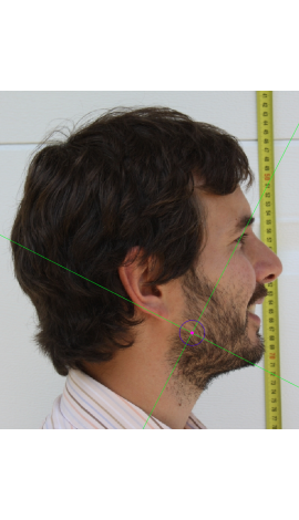 Gonion marking on a photograph in lateral view (center) 