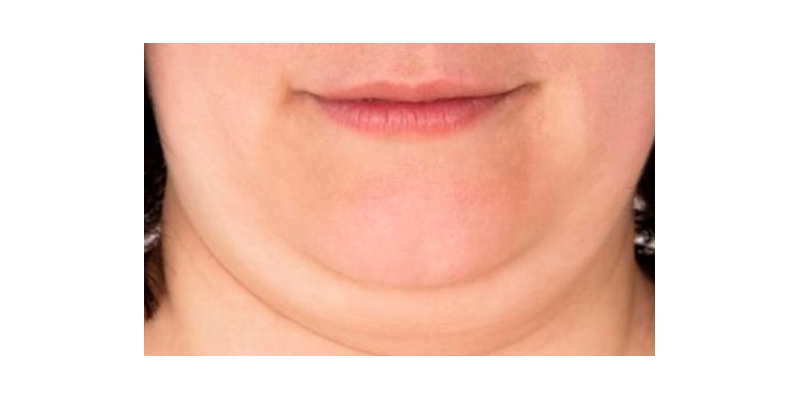 Parte inferior de la cara con acumulación de tejido adiposo que dificulta la observación del contorno facial