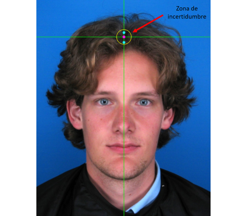 Uncertainty area for vertex marking in subjects with hair