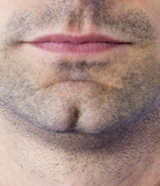 Subject with cleft chin