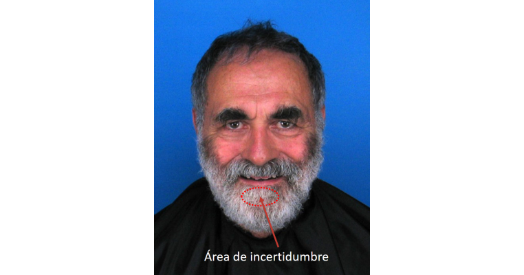 Subject with a thick beard that obscures the view of the mentolabial sulcus