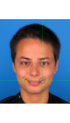 Ejemplos de marcado de cheilion en fotografías en vista frontal