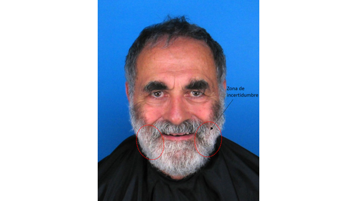 Subject with a thick beard that obscures the view of the facial contour, rendering the location of both gonia unfeasible