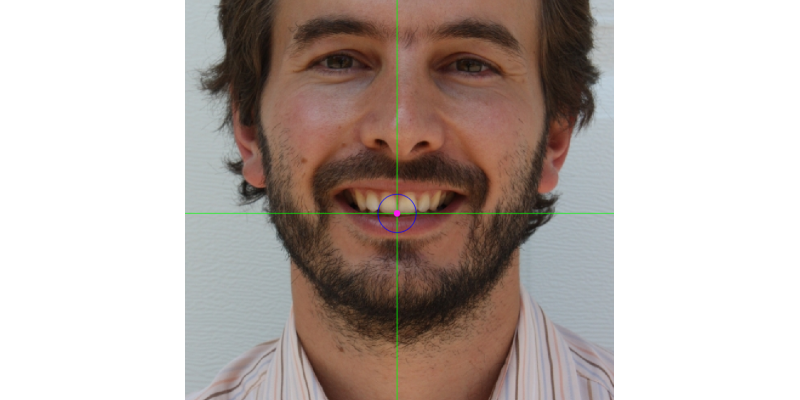 Stomion marking in the occlusal surface at the most inferior interdental contact point when the mouth is not shut in natural pose