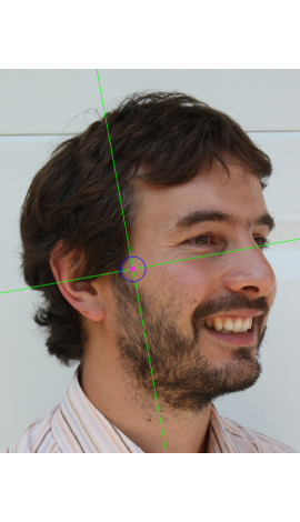 Estimación de zygion en una fotografía en vista oblicua (derecha)