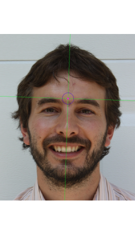 Glabella marking on a photograph in frontal view (left)