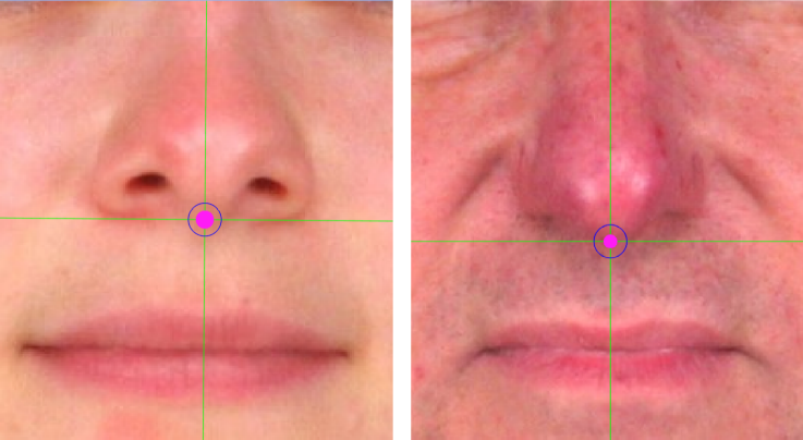 Marking of subnasale in a visible columella (left) and estimation of subnasale in the inferior border of the nasal projection (right)