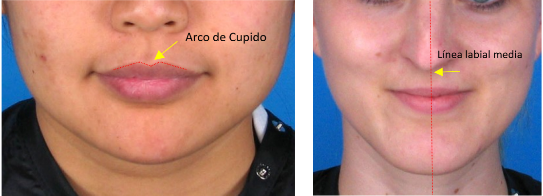 Example of upper lip with Cupid’s bow (left). Reference for the labial middle line to estimate labiale superius in an upper lip where the Cupid’s bow is absent (right)