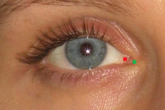 xamples of the precise marking of endocanthion (green dot) and its inaccurate placement (red dot)