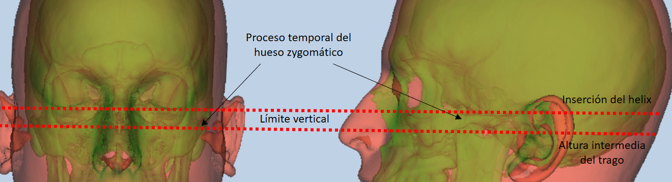 Facial region and references for zygion estimation
