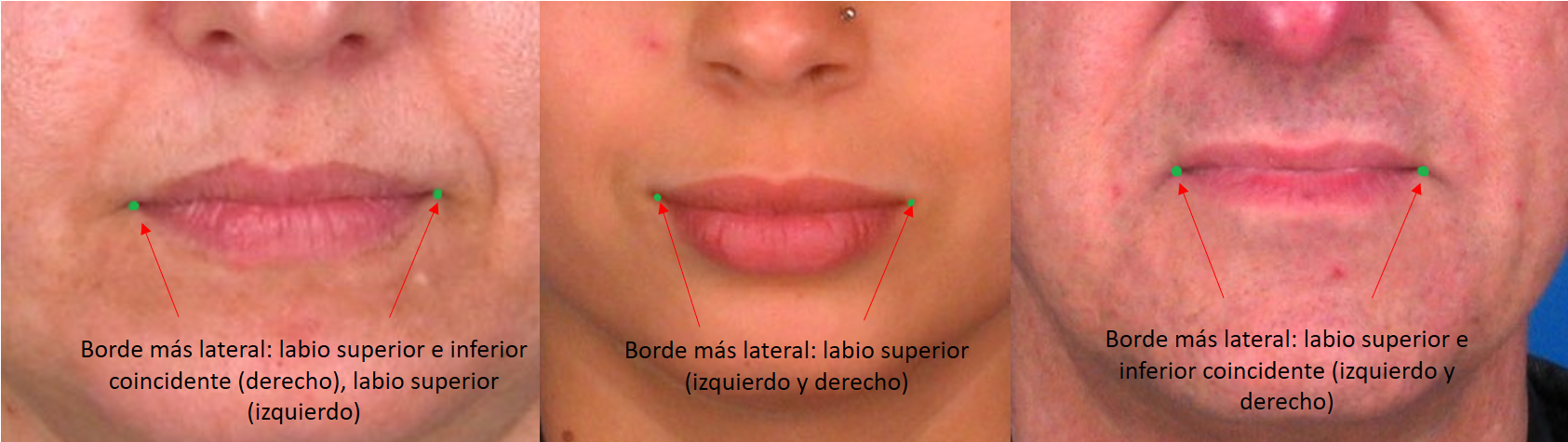 Examples of subjects with different junction points of the upper and lower lips in the rima oris