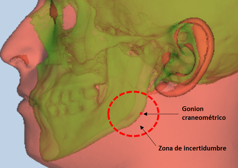 Craniometric gonion and uncertainty area in the soft tissue